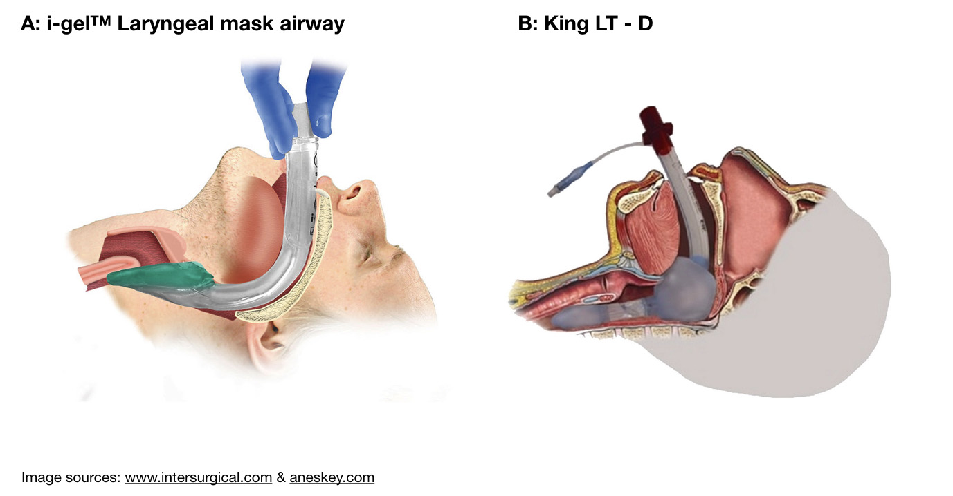 Figure 1: Ideal positioning of LMA-type and LT supraglottic airways.&nbsp;