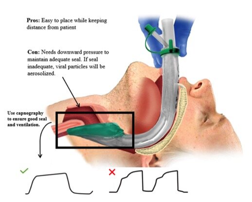 Figure 2: Use of supraglottic airway for COVID patients. Capnography waveforms indicates proper placement with good seal (checkmark) as opposed to a waveform indicating improper placement (X).