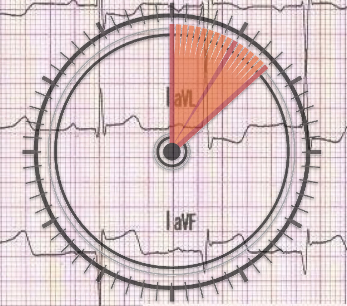 Stemi After Rosc Article Bites #32. 12-Leads After ROSC: It's All in the Timing - NAEMSP