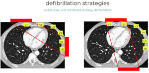 Article Bites #49: Defibrillation Strategies for Refractory Ventricular ...